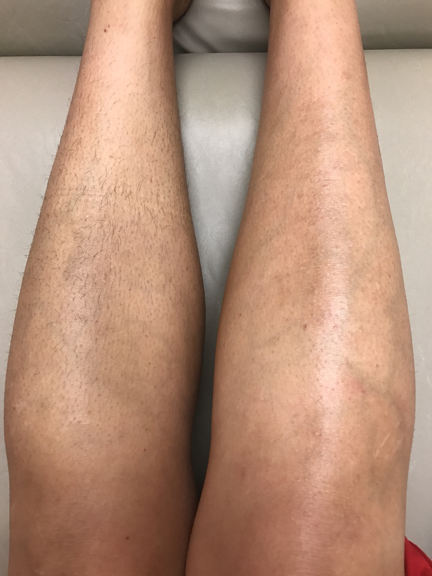 an image of legs during a wax treatment